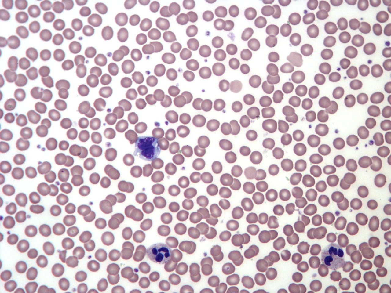 A stained blood smear seen under a light microscope: very many small, round red blood cells with pale centres, one large lymphocyte with a deep purple nucleus near the centre, and two neutrophils with lobed nuclei below