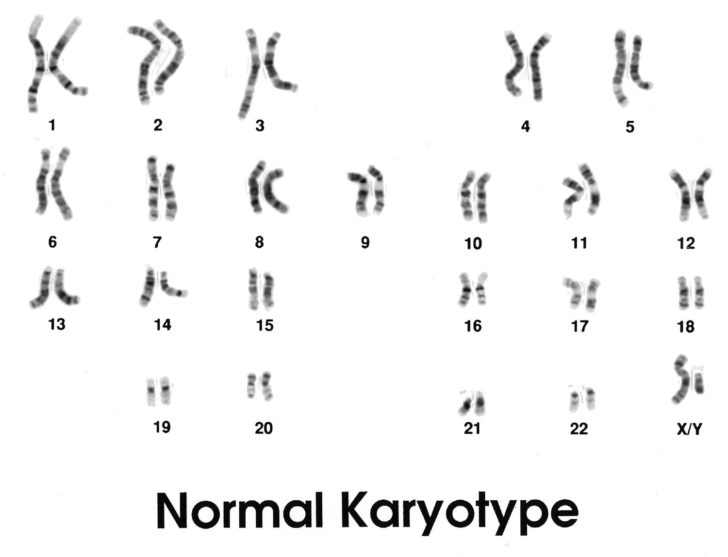 A human karyotype: 46 chromosomes stained to show dark and light bands, sorted into 23 pairs numbered 1 to 22 plus the X and Y sex chromosomes