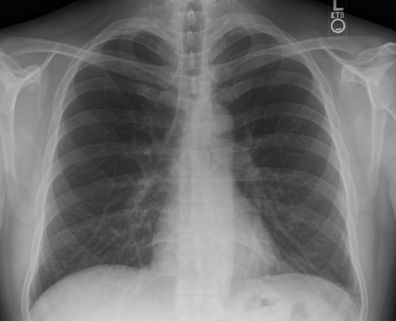 A front-view chest X-ray showing white ribs, spine and the heart shadow against the dark grey of the air-filled lungs